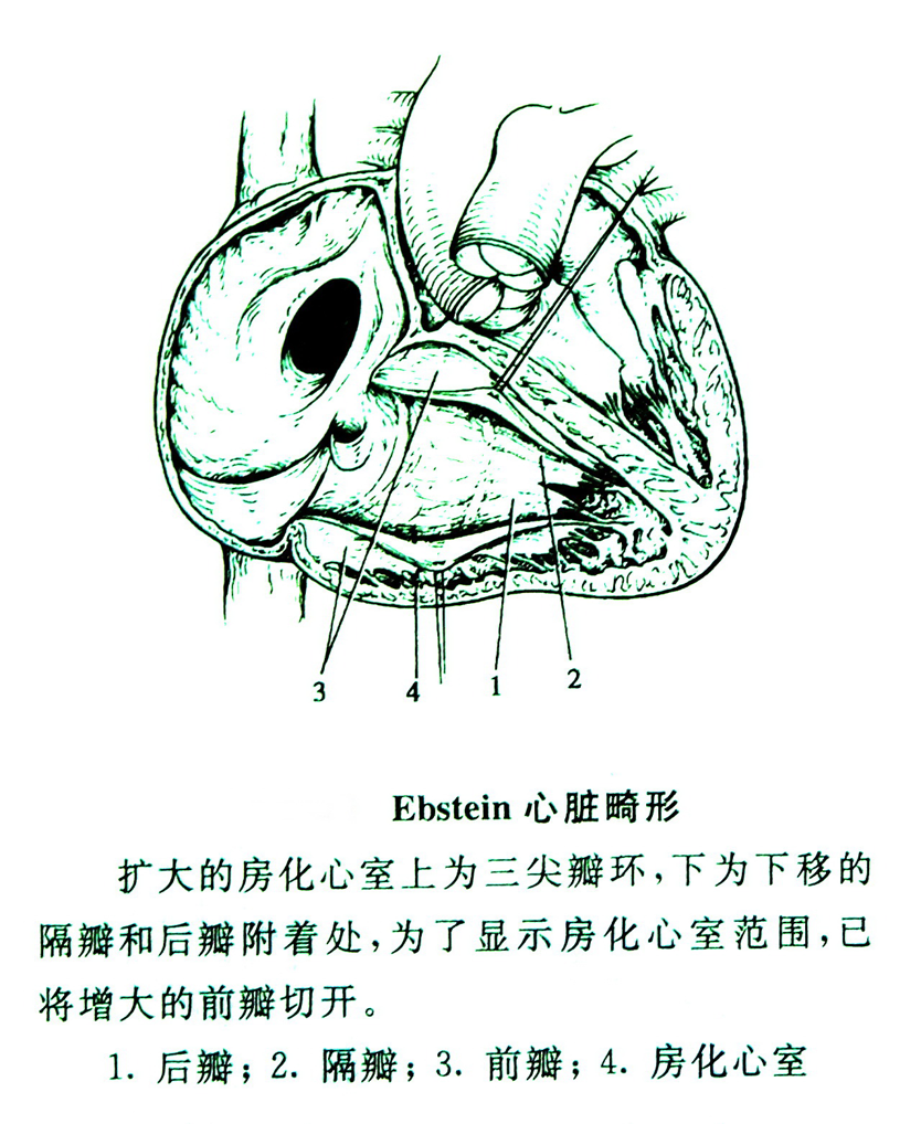 ebstein畸形(三尖瓣下移畸形)矫正术